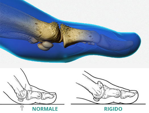 alluce-rigido_1