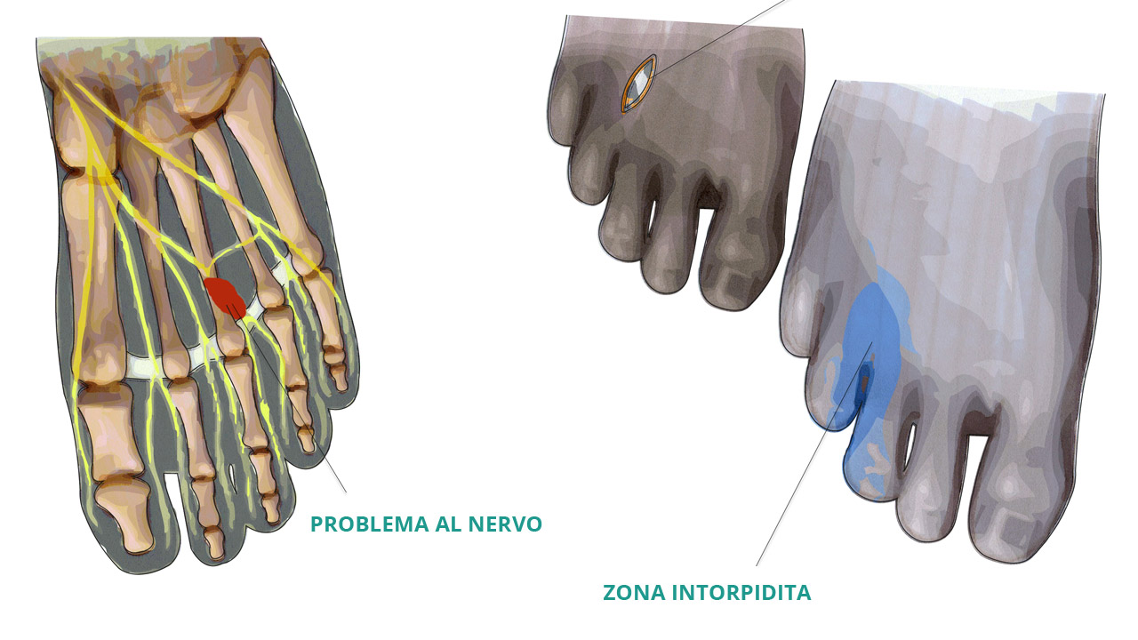 neuroma-di-morton