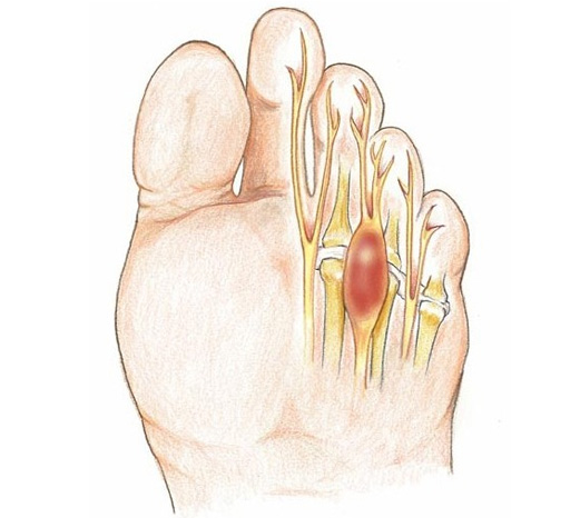 neuroma-di-morton_2