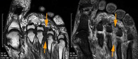 neuroma-di-morton_4